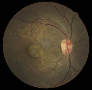 (Top) Fundus photo OD with well-delineated, atrophic macular lesion with surrounding drusenoid deposits.