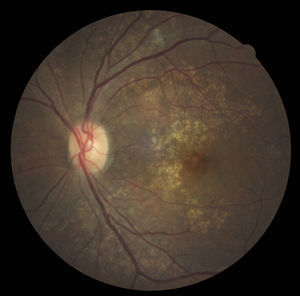 (Top) Fundus photo OS with drusenoid deposits surrounding a mottled, irregular macula.