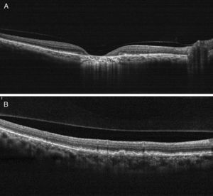 (A) On OCT examination in OD, the atrophic macular area correlated with a total absence of the outer retinal layers with shadowing into the choroid. (B) OCT revealing bumpiness at the level of the retinal pigment epithelium consistent with the drusenoid deposits seen throughout the posterior pole.