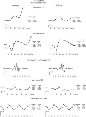 fERG shows normal scotopic responses OU (dark-adapted waveforms above), reduced photopic response amplitudes and minimal delay OU (light-adapted waveforms above), with right eye 30Hz flicker responses slightly reduced compared to left eye. These findings are consistent with the most common fERG pattern seen in patients with central areolar choroidal dystrophy.