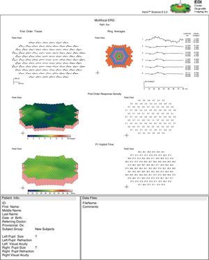 OD mfERG findings show marked 1st order response amplitude reduction across the central retina with a normal to trace delay in implicit time. Note the marked central response amplitude depression in the foveal zone, however the retinal dysfunction noted in the mfERG is not limited to the demarcated central atrophic area as can be seen in the retinal photo (Figs. 1 and 2). This finding of retinal response depression on mfERG testing extending beyond the borders of the ophthalmoscopic lesions has been reported in patients with CACD, and is thought to reflect a more diffuse retinal involvement relative to the clinically evident morphological changes.