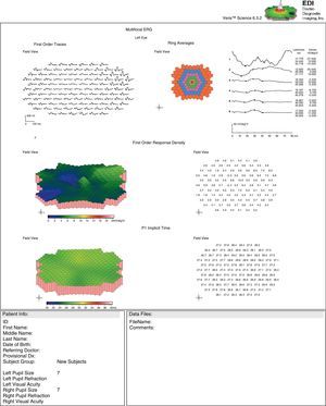 OS mfERG findings showing marked 1st order response amplitude reduction across the central retina with a normal implicit time. While significantly attenuated, there is still the presence of a foveal response peak consistent with the better VA in this eye.