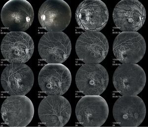 The early frames of the angiogram indicate hyperfluorescence of the lesions corresponding to RPE atrophy. The later frames show loss of the choriocapillaris in the area of RPE atrophy. The hard drusen can be seen as tiny, hyperreflective lesions.