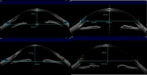 Sagittal depth measurement using the Anterior Segment image of the Visante OCT and the built in callipers. (a) Normal eyes at 15mm chord; (b) normal eyes at HVID; (c) KC at 15mm chord; (d) KC at HVID.