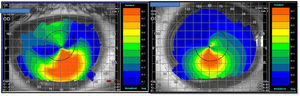 Corneal topography (Tomey, TMS-4). Right image – keratoconus, left image, KC suspect.