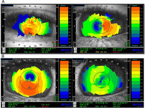(A) Corneal topography (Tomey, TMS-4) before treatment for ADHD. (B) Corneal topography after treatment for ADHD.