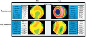 Representation of total ocular wavefront before and after treatment for ADHD (L80 Wave+).