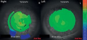 Corneal topography (L80 Wave+, Luneau, France) in 2013, three years after start of treatment.