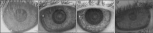 A set of 4 representative videokeratoscopy images with tear film-related interference (irregular patterns-due to tear thinning and break-ups). Note that the areas in the image containing shadows from the eyelashes are not considered in this study. These example images I–IV are used to examine aspects of the performance of the proposed image processing technique.