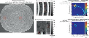 Two representative blocks (centre) from a videokeratoscopic image (left) with their corresponding co-occurrence matrices (right). The top subplots represent an example with optimal reflection conditions (good tear film) while the bottom subplots represent suboptimal reflection conditions (poor tear film). The red lines in the central block image illustrate the pixels in each of the block images with occurrence values of grey level equal to (3,4) (see text for details).