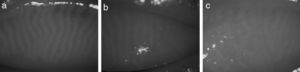 Samples from captured IR images of the inner upper eyelid showing Meibomian glands. The grading from an expert is (a) healthy, (b) intermediate, and (c) unhealthy.