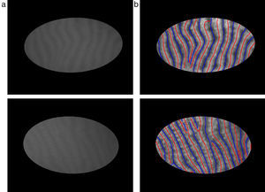 Finding mid-lines of gland and inter-gland regions: (a) corresponding input 576×768 pixels image with superimposed region of interest and (b) detected mid-lines of gland and inter-gland regions labeled with red and blue lines, respectively, using skeletonization. (For interpretation of color in the artwork, the reader is referred to the web version of the article.)