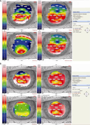 Topographies of the right and left eye demonstrating 10.44 and 3.57 diopters of irregular astigmatism.