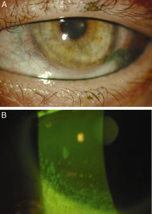 Lissamine green and sodium fluorescein staining of the conjunctiva and cornea pre-MSD lens fit.