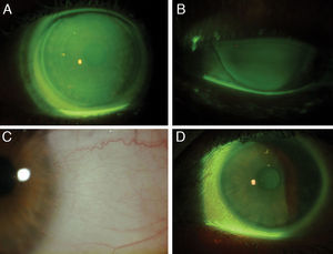 Final MSD lenses of the right and left eye. Lissamine green and sodium fluorescein staining post-MSD fit.