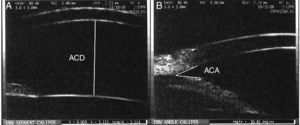 (A) Anterior chamber depth (ACD) was determined by measuring the distance between the posterior surface of the central cornea and the most central portion of the anterior lens capsule. (B) Anterior chamber angle (ACA) width was measured as the angle formed between two lines coursing parallel to the anterior surface of the peripheral iris and peripheral portion of the posterior corneal surface.