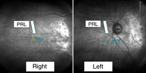 PRL on corresponding retinal areas.