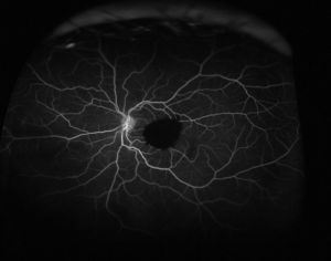 Fluorescein angiogram of the left eye shows blockage of fluorescein by the preretinal hemorrhage and no leakage is observed from the presumed location of the RAM.