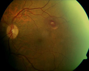Two weeks status-post pars plana vitrectomy, a resolving RAM is visible along the superior-temporal arcades surrounded by resolving sub-retinal blood.