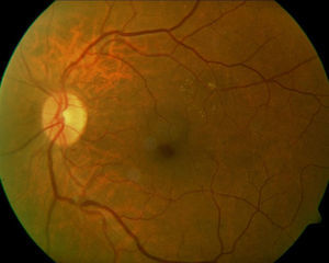 Five months status-post pars plana vitrectomy, resolution of the RAM is nearly complete.
