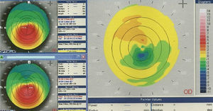 Difference topographic map of an eye with keratoconus 4 years after epithelium off CXL showing the typical picture of flattening of the apex of the cone (green colour) with some slight steepening of the adjacent superior hemi-meridian (orange colour). Such changes are associated in an improvement in corneal higher order aberrations, especially vertical coma, and accompanying enhancements in visual performance.