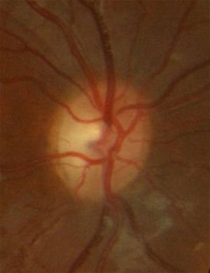 Optic disk temporal pallor after an episode of bilateral optic neuritis in a 13 years-old patient with a VA of 0.2 (decimal scale).