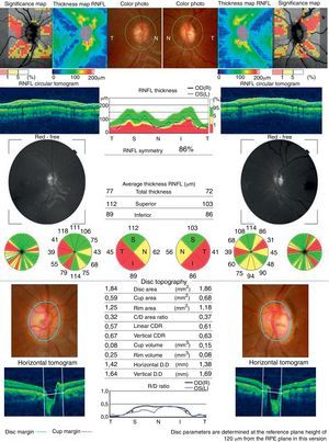 Papillary optical coherence tomography showing a retinal fibers layer thinning in a 13 years-old patient after an acute episode of bilateral optic neuritis.