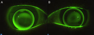 Contact lens fitting fluorescein patterns showing: (A) apical-touch fitting approach and (B) three-point-touch fitting approach.