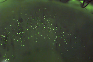 Mucin balls cause corneal indentations, showed by pooling of fluorescein.
