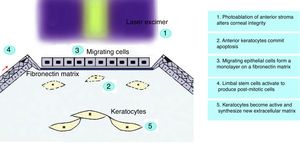 Corneal alterations and first steps of wound healing following PRK.