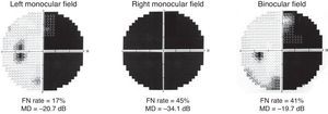Grayscale results of monocular and binocular 30 degree threshold visual field testing. Unlike most patterns seen in VCD, these results are optically possible. False negative (FN) rate and mean deviation (MD) are shown for each test.