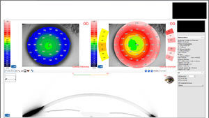 Output screenshot of the glaucoma summary mode of Sirius Scheimpflug analysis system (CSO, Italy) showing the measured parameters.