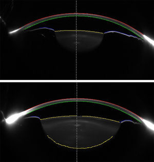 Scheimpflug images of an eye before (top) and after (bottom) pharmacologic mydriasis. Different surfaces of the anterior segment are traced by the device and used for analysis. Anterior Chamber (AC) depth is measured from the posterior cornea to the anterior lens surface at the midline (dashed line). Data from posterior cornea, anterior lens, and anterior iris surfaces are analyzed for calculating AC volume.