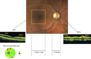 Schematic of the retinal zone assessed for inner retinal thickness.