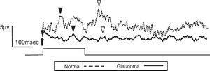 Electroretinogram responses from a normal subject (54-year-old male) and a glaucoma patient (61-year-old male). The arrow indicates stimulus onset. After the 250-msec stimulus, on (▾) and off (▽) responses were identified. The glaucoma patient had bilateral pseudophakia, best-corrected visual acuity in the tested eye (OD) was 20/25 with mild hyperopia (+0.5 diopter), and the intraocular pressure was 14mmHg. The thickness of the retinal ganglion cell complex layer was 60μm and mean deviation examined by perimetry was −21.1dB. The disk/cup ratio was 0.82. Neither on nor off responses were observable on the waveform recorded from the glaucoma patient.