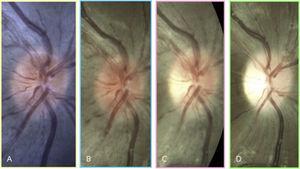 A 9-year old Asian male with LHON m.11778 presents with best-corrected visual acuity of 20/20 in the right eye and no symptoms (A). At age 12, retinal nerve fiber layer swelling is observed prior to reduction in vision (B). His visual acuity rapidly decreases 1 month later to 20/50 and subtle temporal optic nerve pallor is visible (C). Three months later, his visual acuity is <20/400 and diffuse optic nerve pallor is present (D). Notice that peripapillary telangiectasia was present at age 9 -three years before his visual symptoms started. The patient's left eye progressed similarly to the right eye.