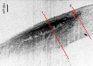 OCT image showing the corneo-scleral limbus. The red arrow shows the termination of the epithelium-Bowman