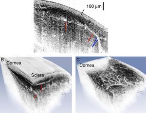 (A) Representative OCT B-scan of a healthy human corneo-scleral limbus. Black arrow marks the conjunctiva. Red arrows mark limbal blood vessels. Blue arrows mark individual red blood cells in the major scleral blood vessel. (B) Three dimensional reconstruction of a set of UHR-OCT tomograms. This reconstruction can be sliced at different angles and the vessels assessed and measured with the requisite ellipse or circle tool. Red arrows mark cross-sections of scleral blood vessels. (C) Three dimensional reconstruction of the limbus with the epithelium stripped through an oblique slice to reveal the vessel structure within the limbus. In (B) and (C) the images were black/white inverted so that the limbal voids being mapped appear as white against a dark background to allow enhanced viewing for readers.