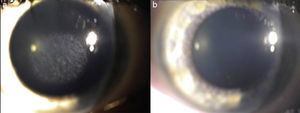 Post-PRK corneal haze before (a) and after (b) treatment with stromal scraping and application mitomycin C. Spadea & Verrecchia. 2011. The Open Ophthalmology Journal.