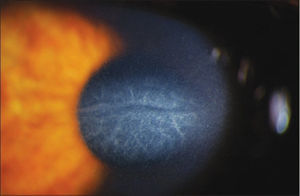 Central Toxic Keratopathy with loss of central corneal transparency. Image reproduced under Creative Commons Attribution License. Hazin R et al., 2010. Middle East Afr J Ophthalmol. http://www.ncbi.nlm.nih.gov/pmc/articles/PMC2880375/.