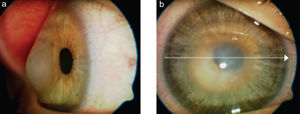 In this image we can appreciate post-LASIK keratectasia with cornea budged forwards and edematous central cornea. Image reproduced under the CC-NY License. Meyer H et al., 2009. J Ophthalmol. http://www.ncbi.nlm.nih.gov/pubmed/20339447.