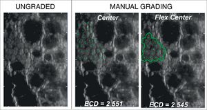 Representative sample cornea with severe guttata (guttae covering >40% of the viewable field) resulting in a drastically low number of gradable cells (INP<100) graded by different manual methods.