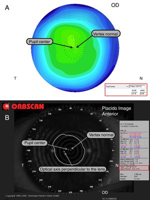 Differences between Orbscan (A) and Pentacam (B). Orbscan reports Kappa angle as the distance from vertex normal to optical axis of the lens.