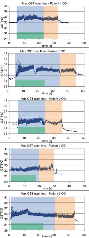 Maximum ocular surface temperature (OST) versus ablation time for all the 5 eyes (Green area demonstrates epithelial ablation; blue area demonstrates ablation under high fluence and pink area demonstrates ablation under low fluence). In Patient 1 OS, the treatment was interrupted two times due to re-centration of eye and surgical maneuvers, which corresponds to the drop in temperature at two places in the graph.