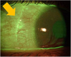Conjunctival imprint after ScCL removal, indicating the landing zone area of the lens. This picture was obtained in one of the patients of the study during the initial fitting trials.