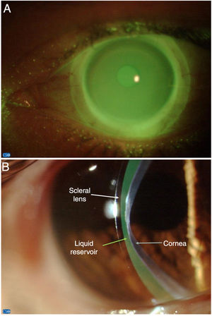 Frontal view of the miniscleral contact lens fitting (A) and relationship with the ocular surface (B).