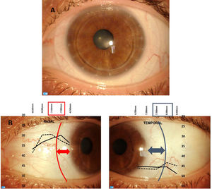 (A) Infero-temporal decentration of a ScCL. (B) Conjugation of results from Fig. 5A with figures from the nasal and temporal portion, demonstrating that the changes found on scleral tangent angles could coincide with the scleral lens haptic zone. Red (nasal) and blue (temporal) lines are overlapped with the landing zone of the lens, that is nearest the limbus on the nasal side than on the temporal side. The inferior-temporal part of the lens is visible in the bottom-right image.