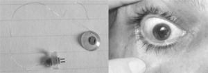 Gas-permeable doughnut-shaped CL (left) with a piezoresistive nanocomposite developed by Sanchez et al. Proof-of-concept prototype of a CL in a volunteer