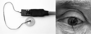 DCT lens (left) with piezoresistive nanocomposite manufactured by Ziemer Ophthalmic Systems Company. Proof-of-concept prototype of the CL in a volunteer