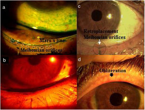 Lid margin. (a) Extension of green lissamine toward meibomian orifices: Marx's line; (b) red filter show irregularity of lid margin; (c) retroplacement of Meibomian orifices; (d) obliteration. The punctum of the orifice may not be visible and vascular invasion is visible.